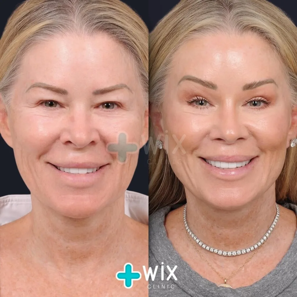 Facelift before and after