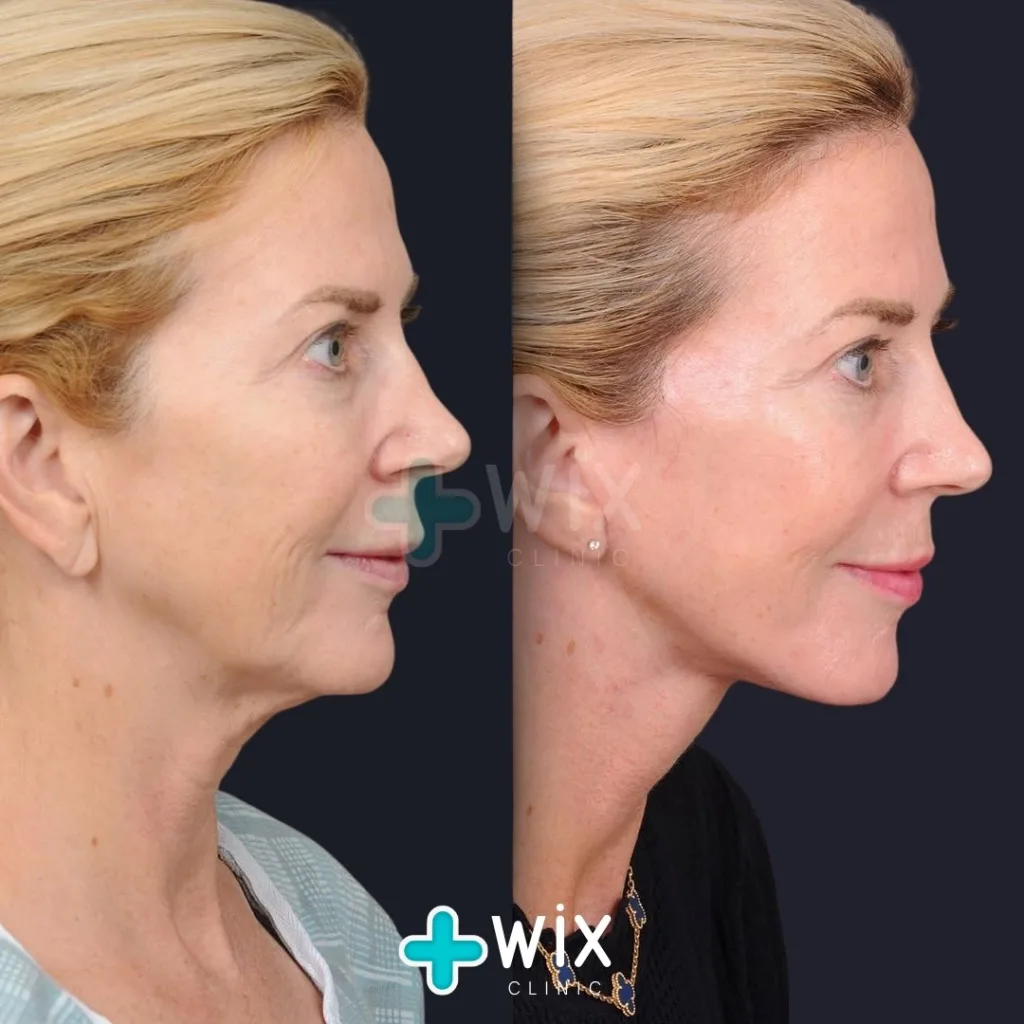 Facelift before and after