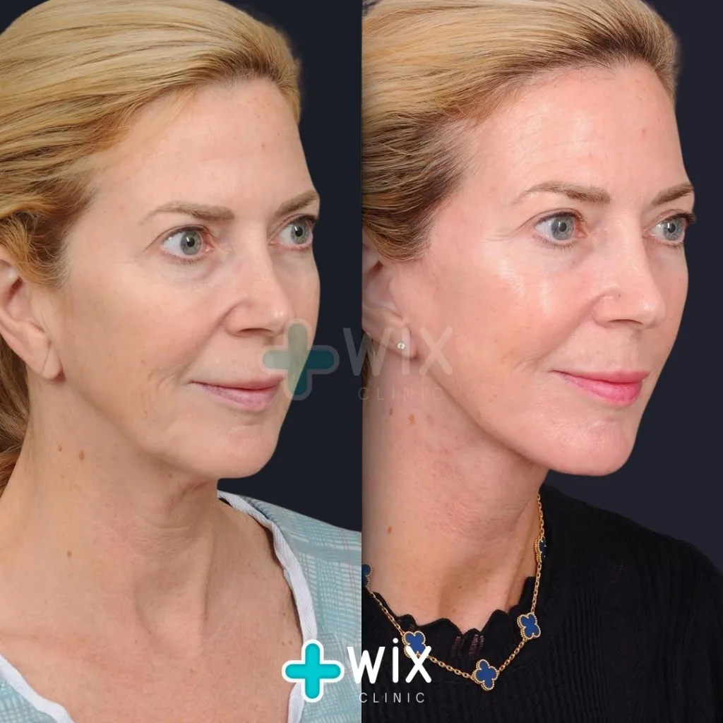 Facelift before and after