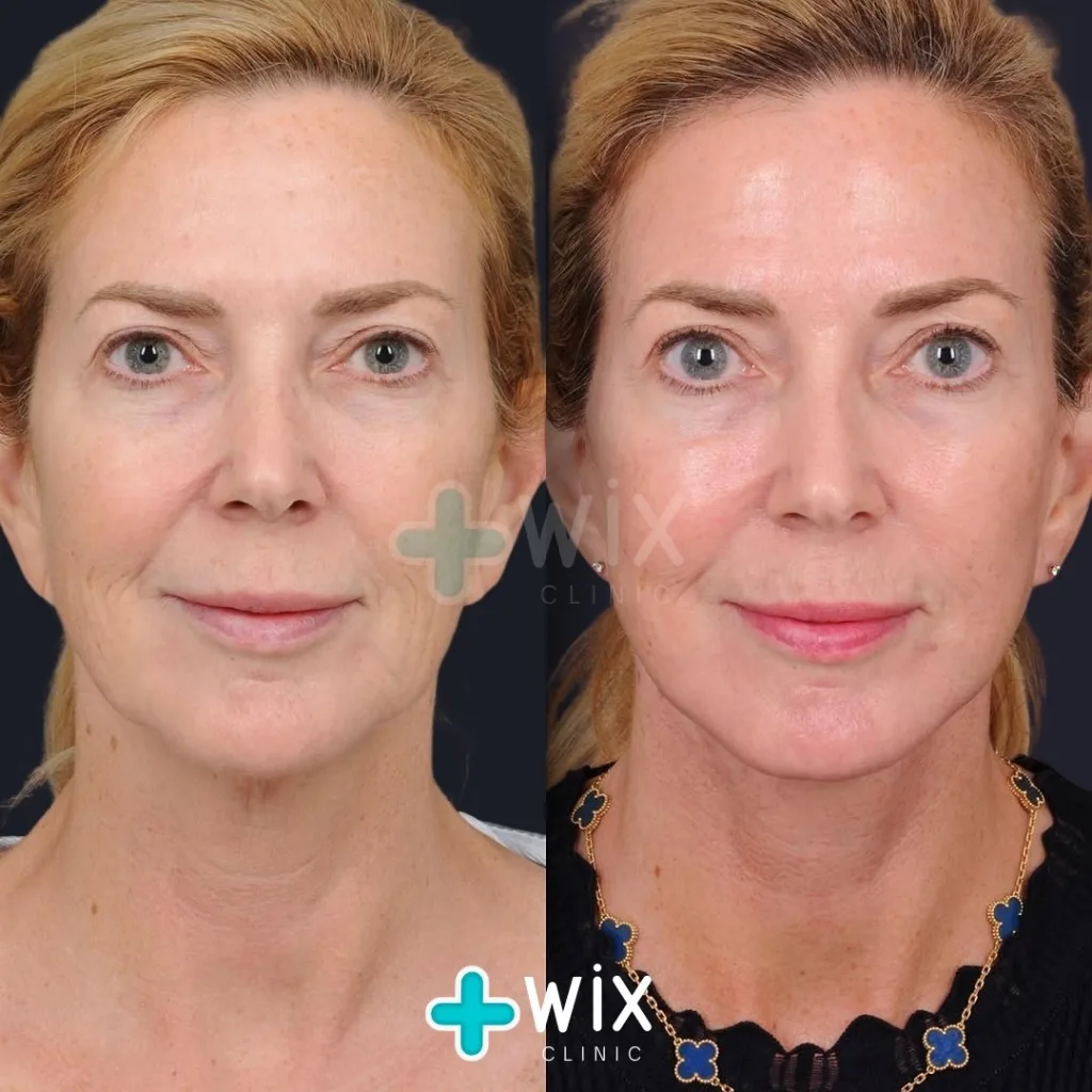 Facelift before and after