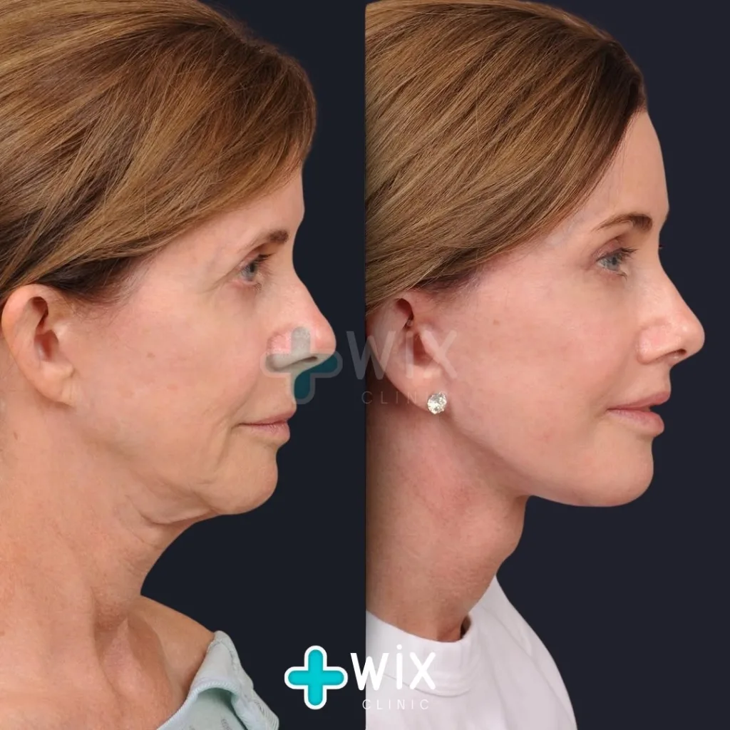 Facelift before and after