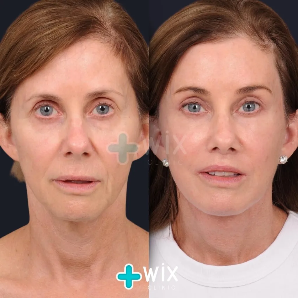 Facelift before and after