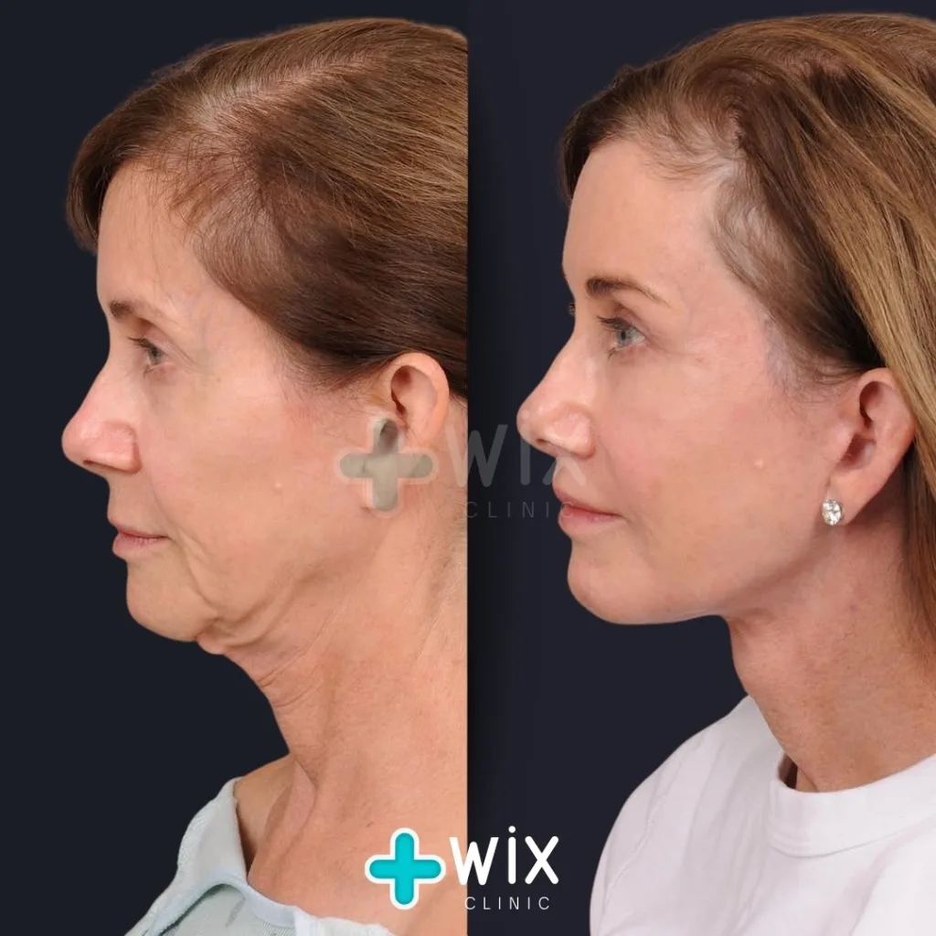 Facelift before and after