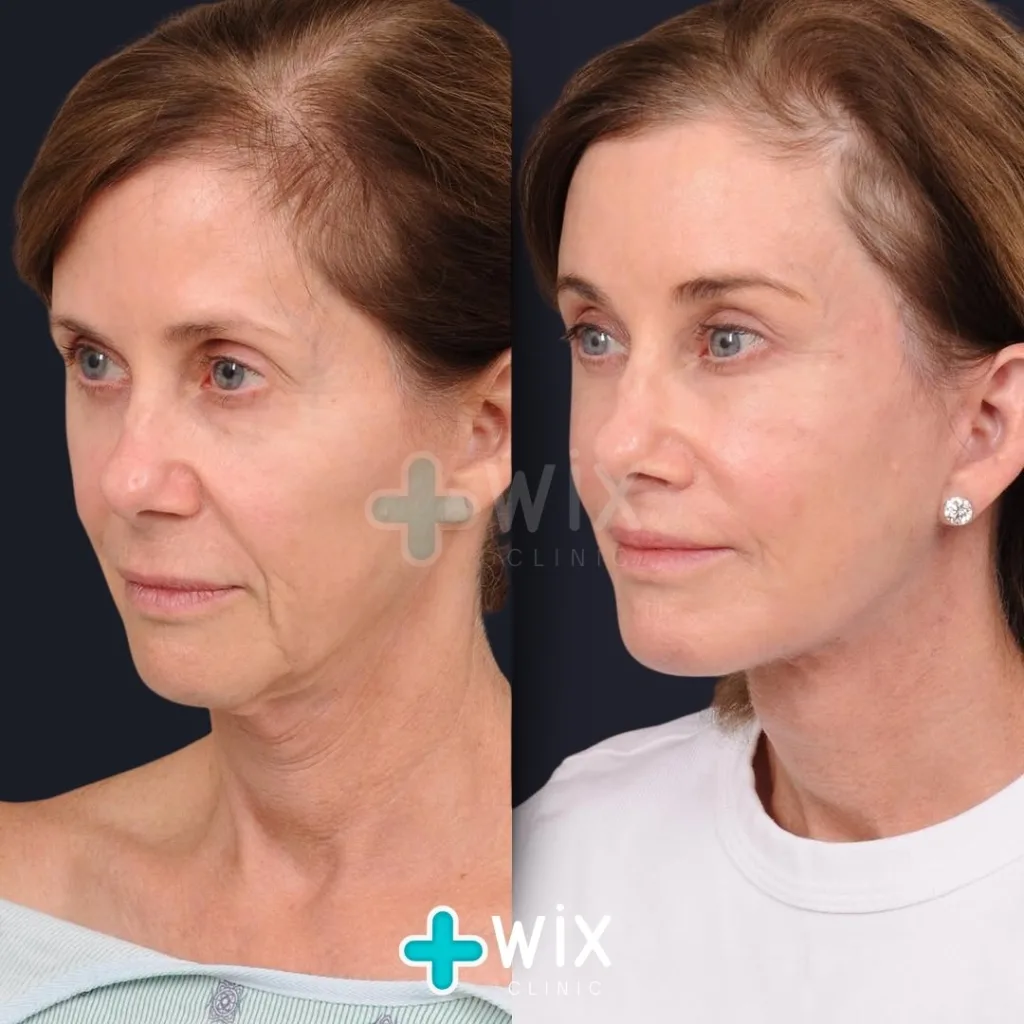 Facelift before and after