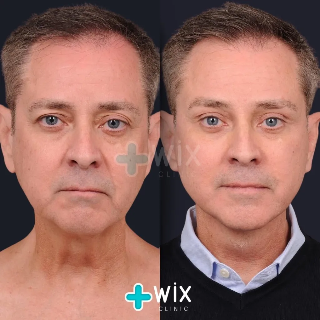 Facelift before and after