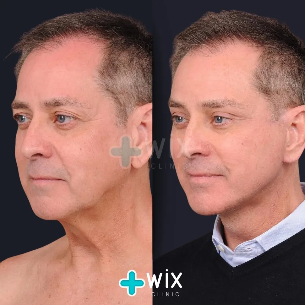 Facelift before and after