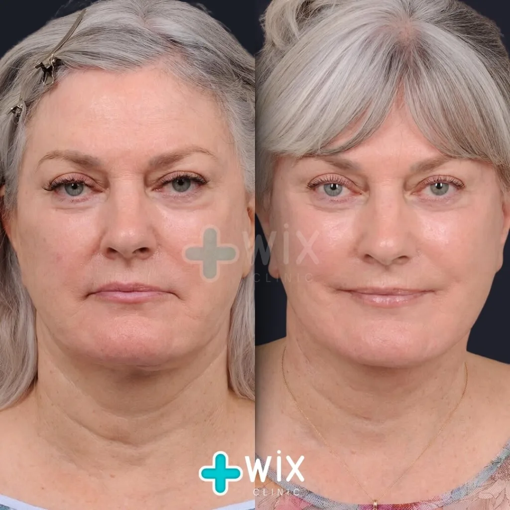 Facelift before and after