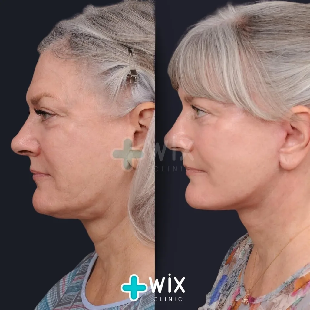 Facelift before and after