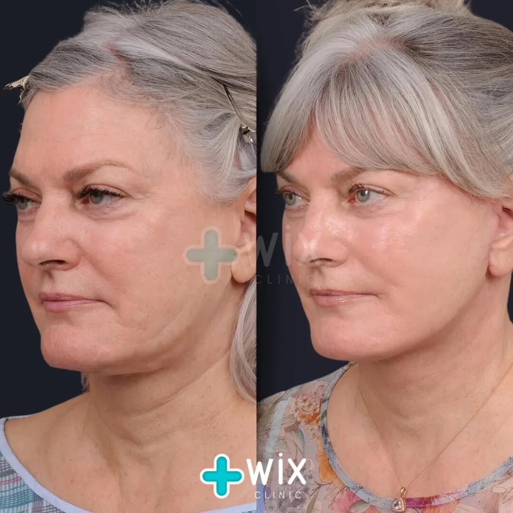 Facelift before and after