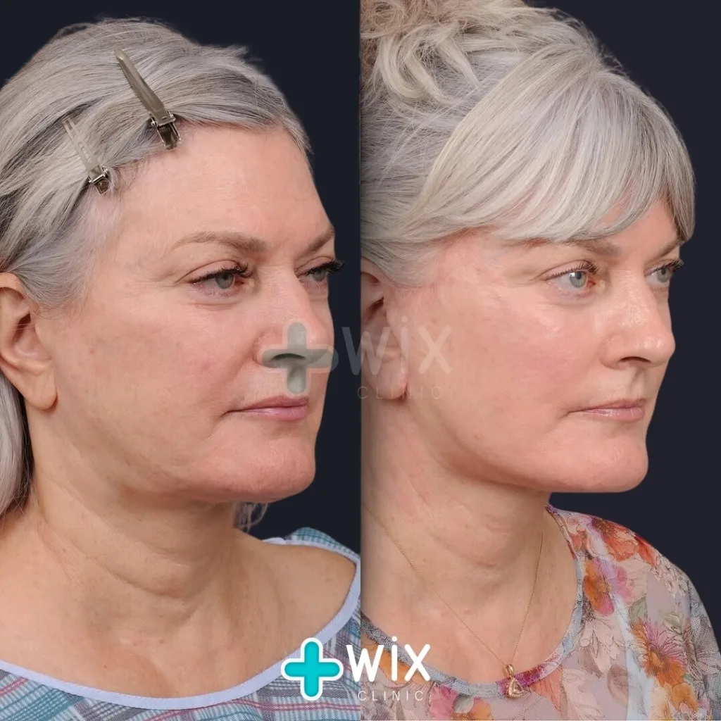 Facelift before and after