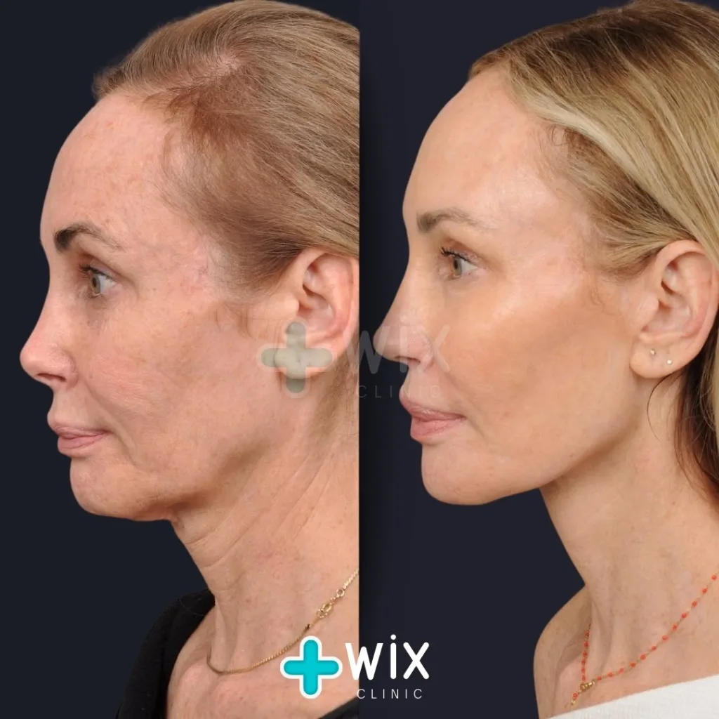 Facelift before and after