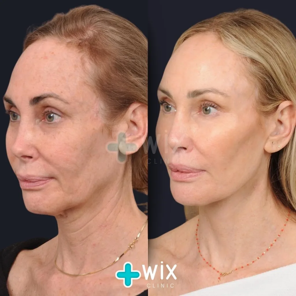 Facelift before and after