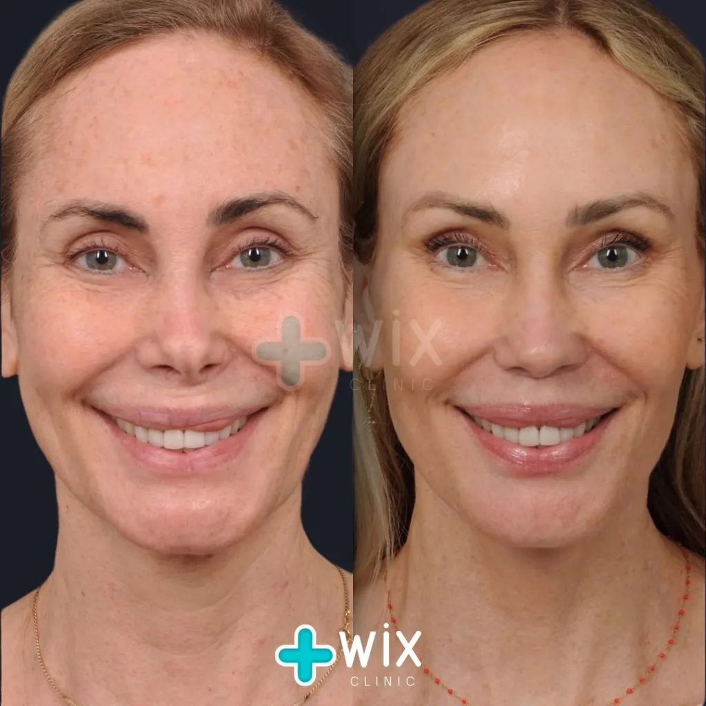 Facelift before and after