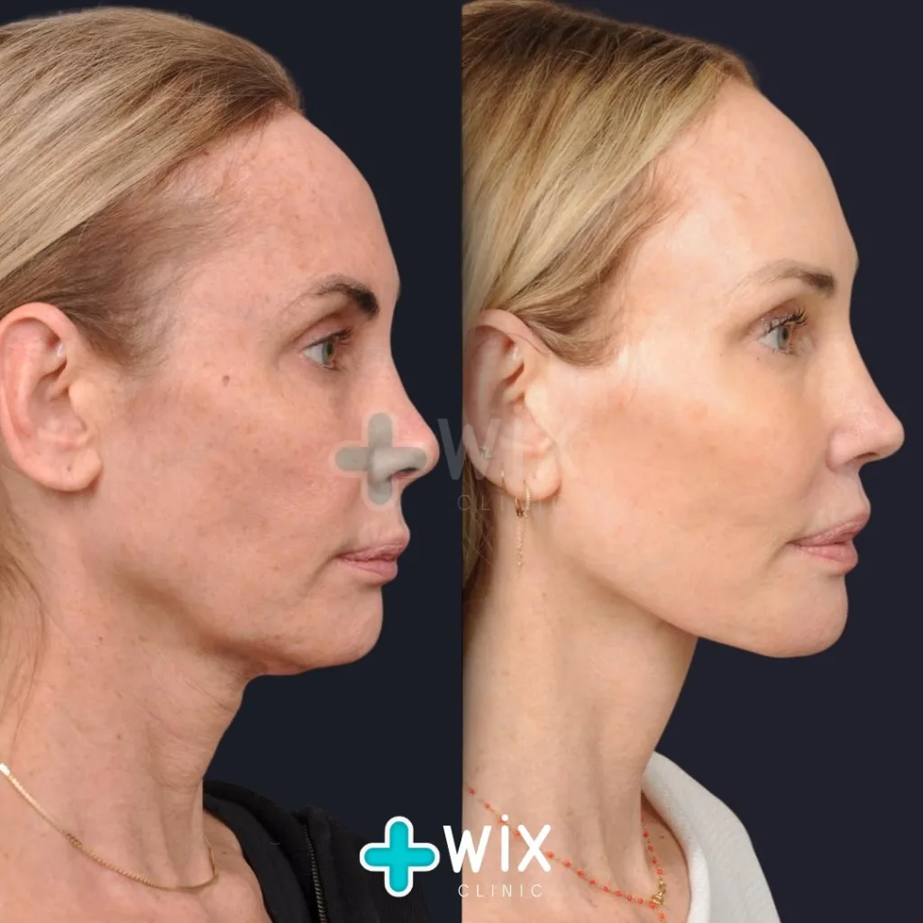 Facelift before and after