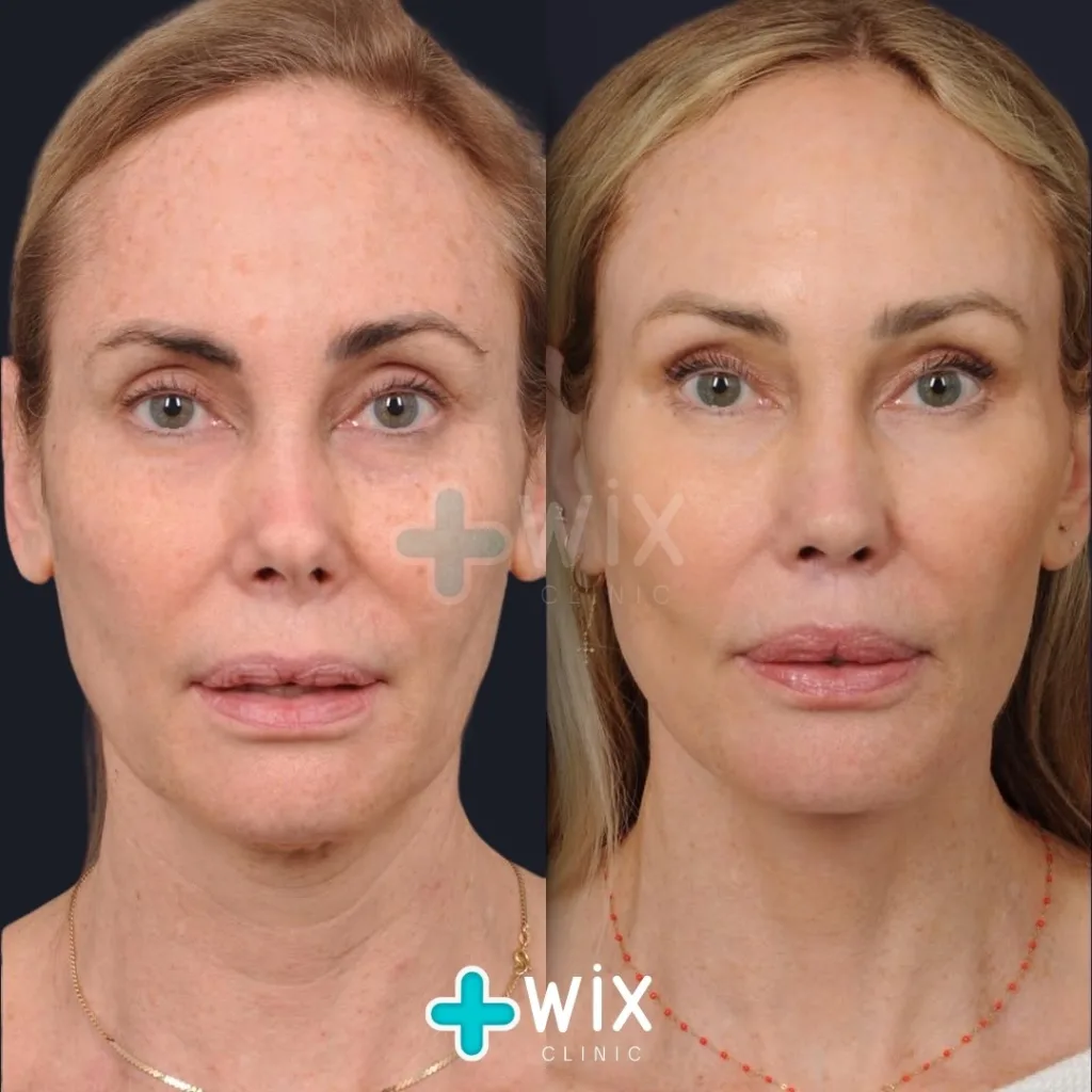 Facelift before and after