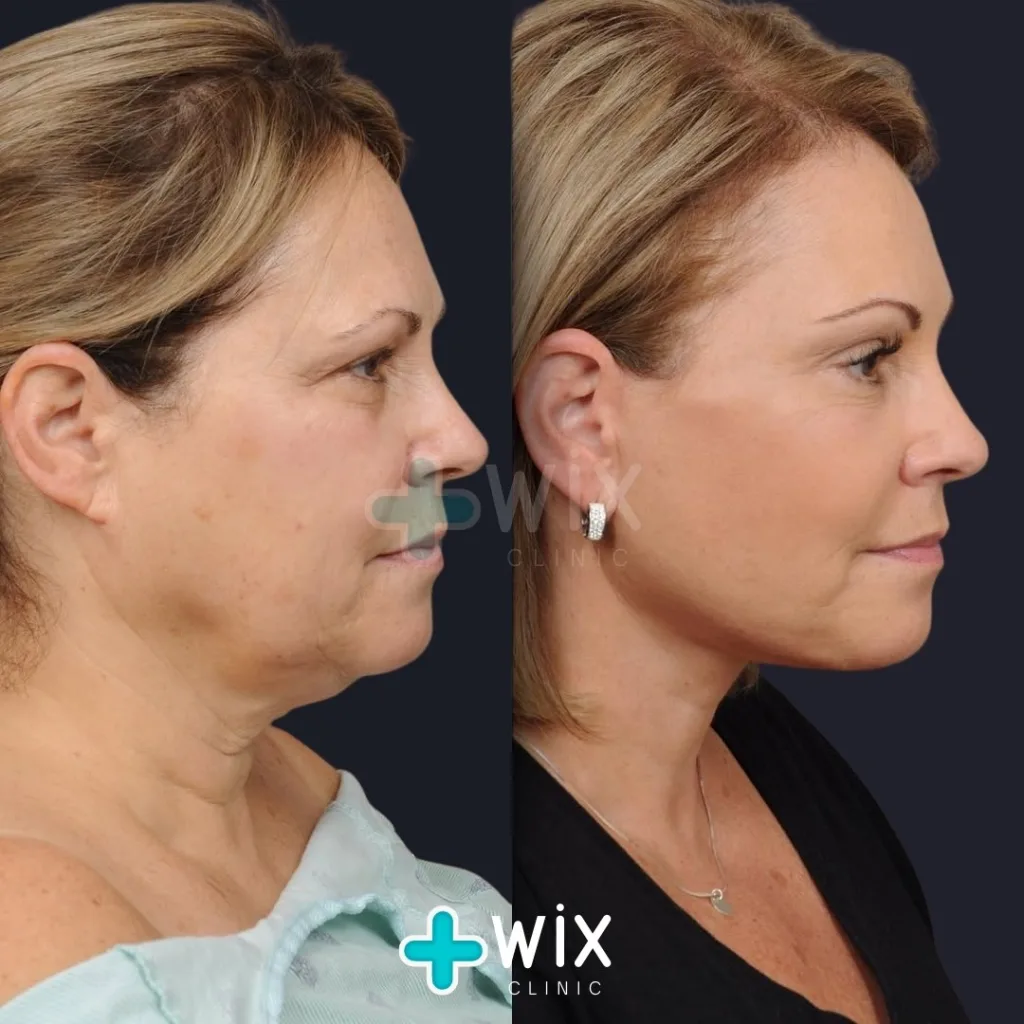 Facelift before and after