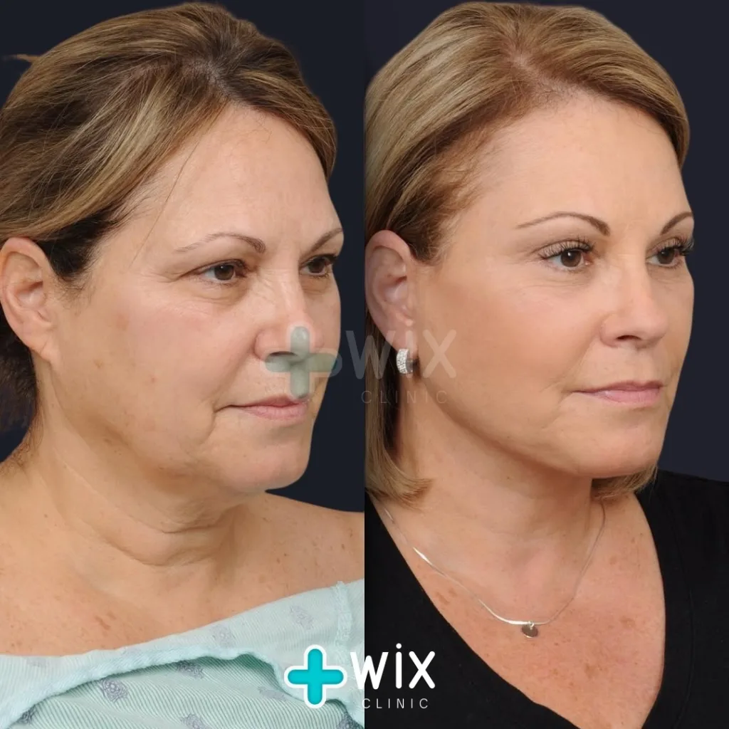 Facelift before and after