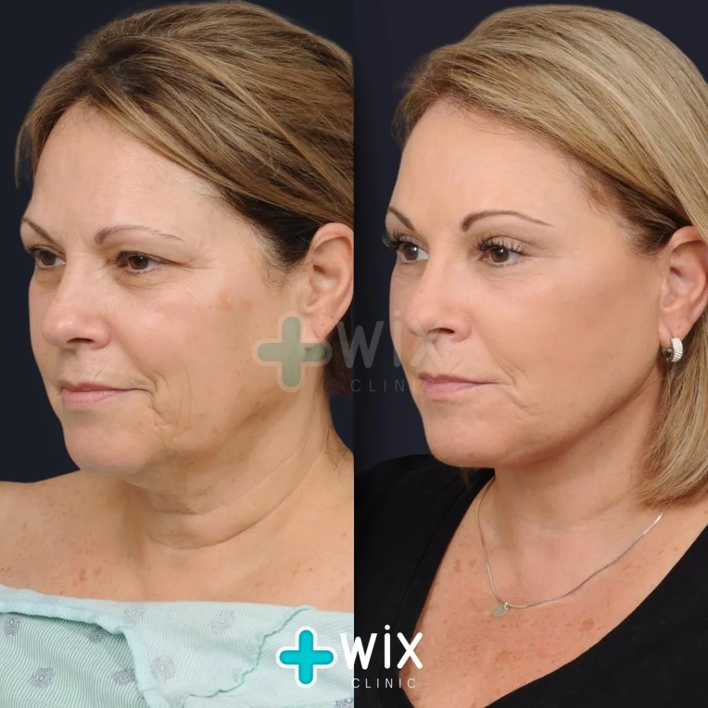 Facelift before and after