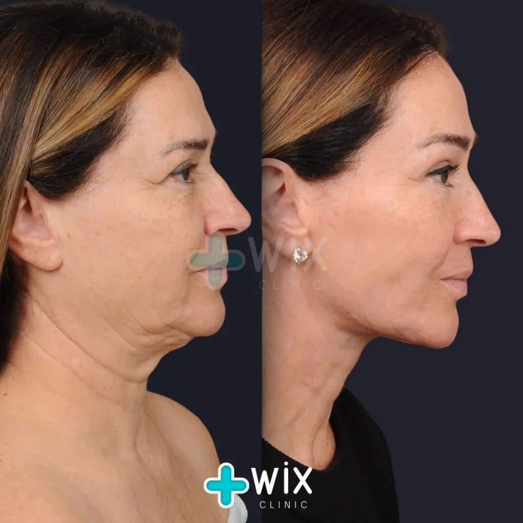 Facelift before and after