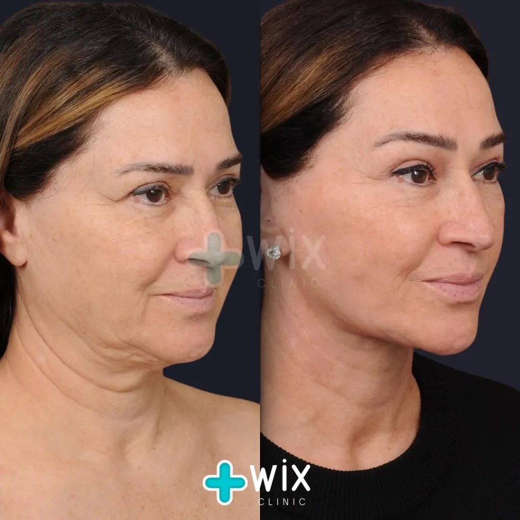 Facelift before and after