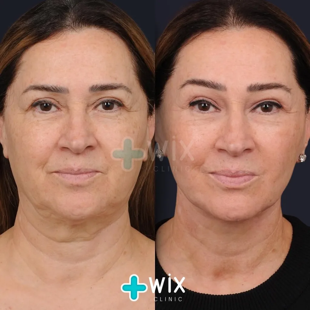 Facelift before and after