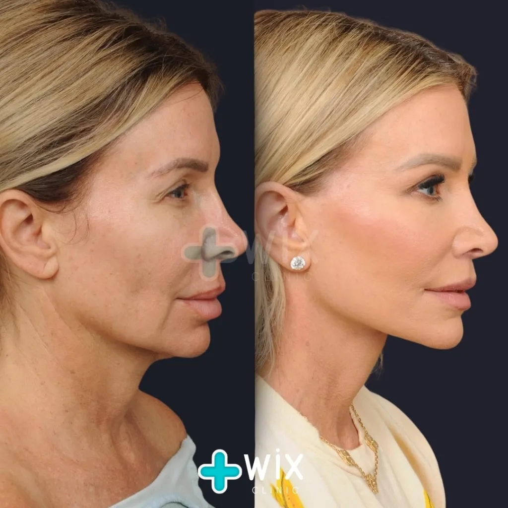 Facelift before and after