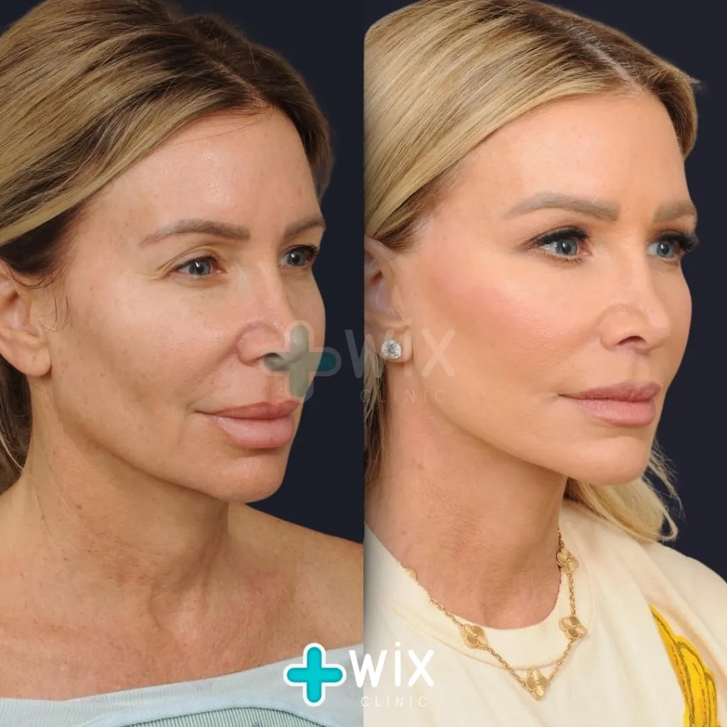 Facelift before and after