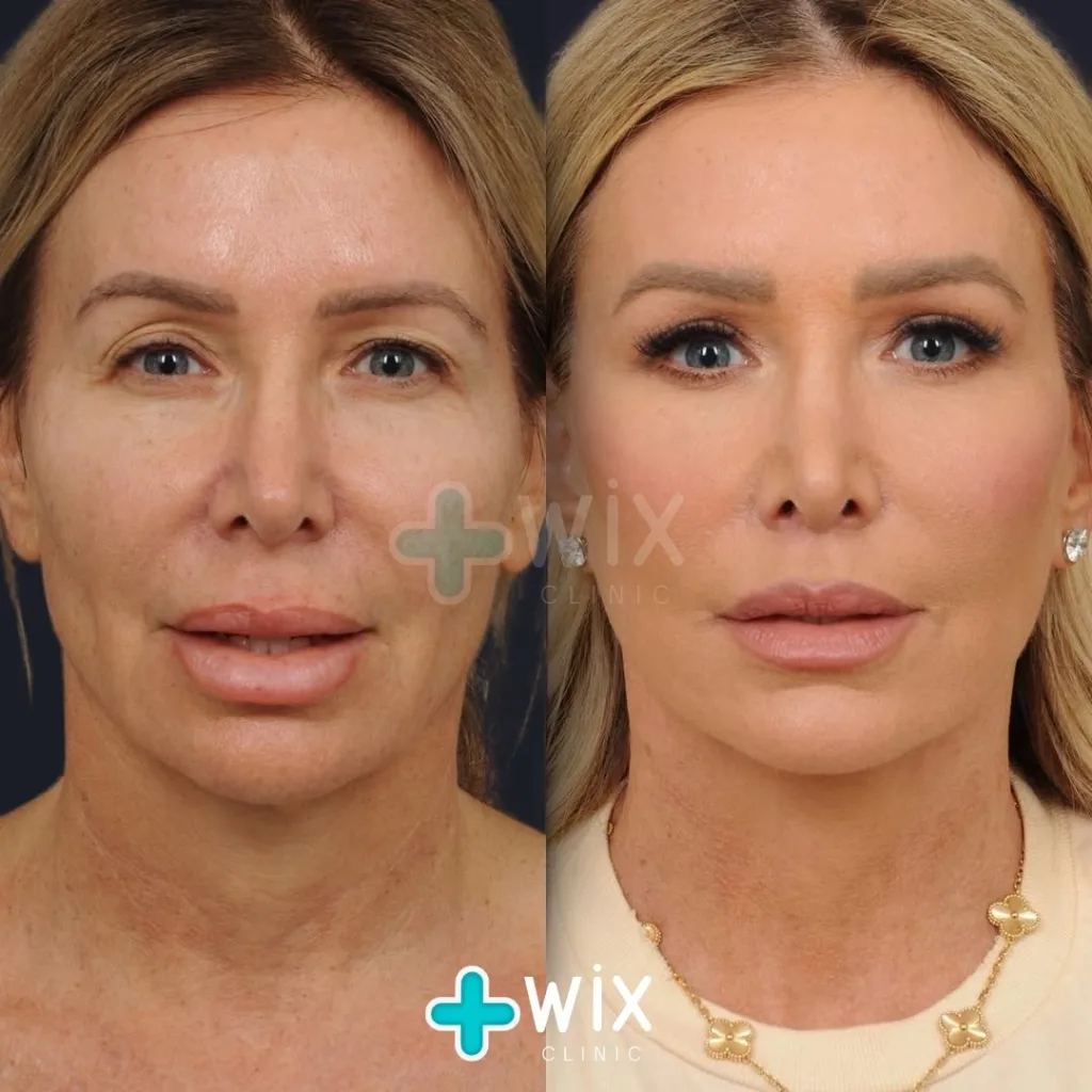 Facelift before and after