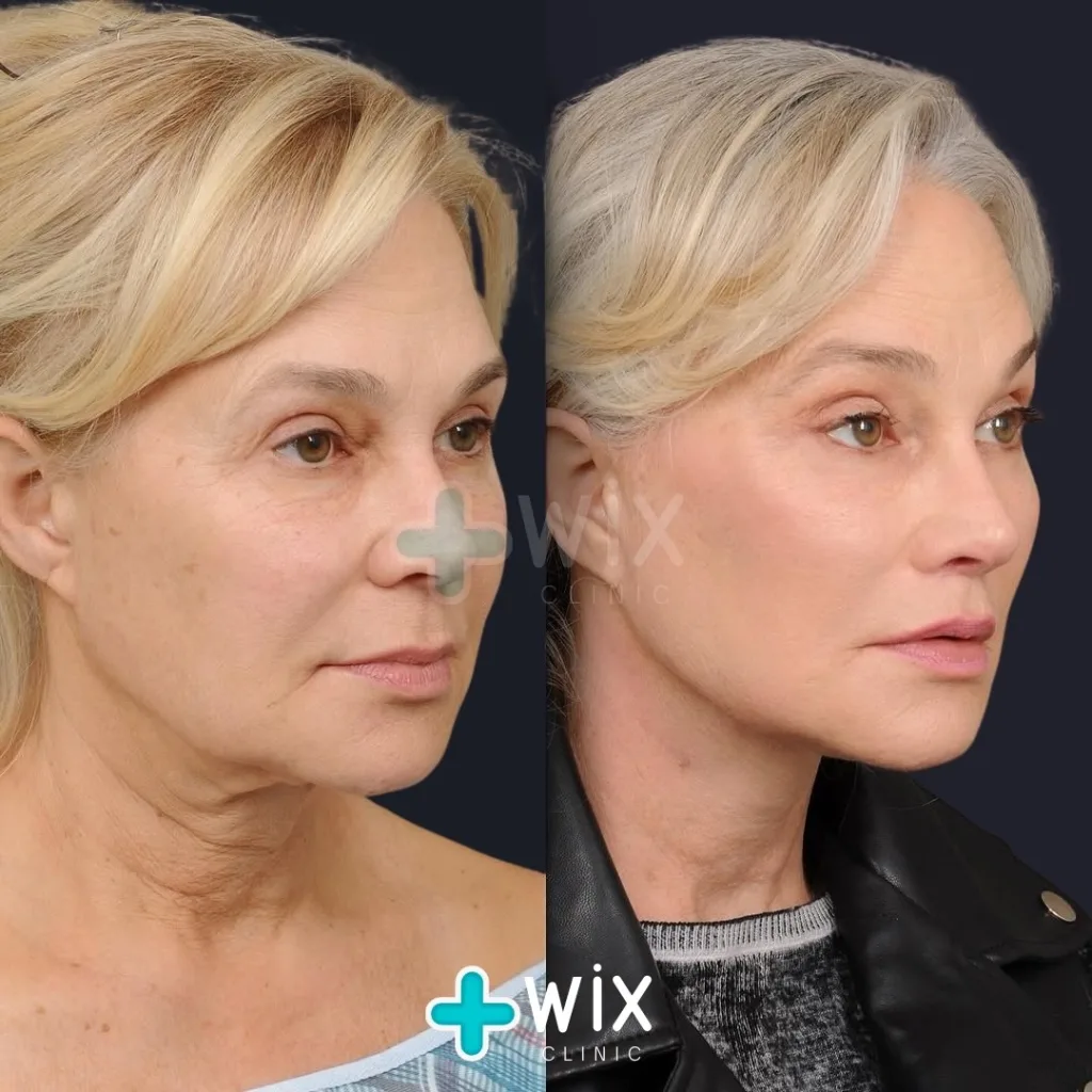 Facelift before and after