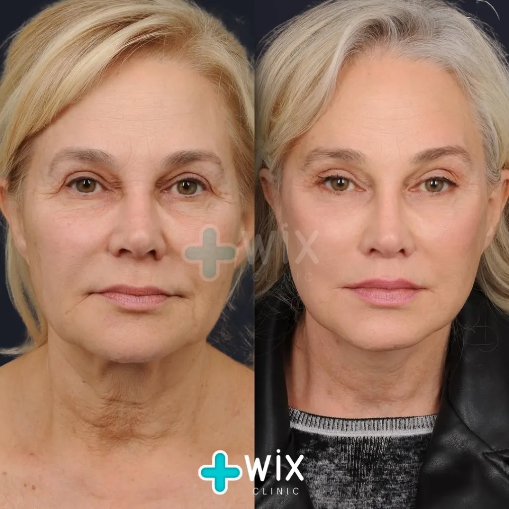 Facelift before and after