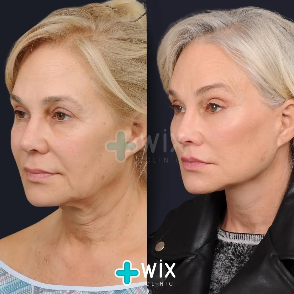 Facelift before and after