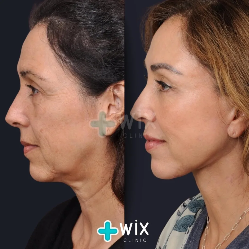 Facelift before and after