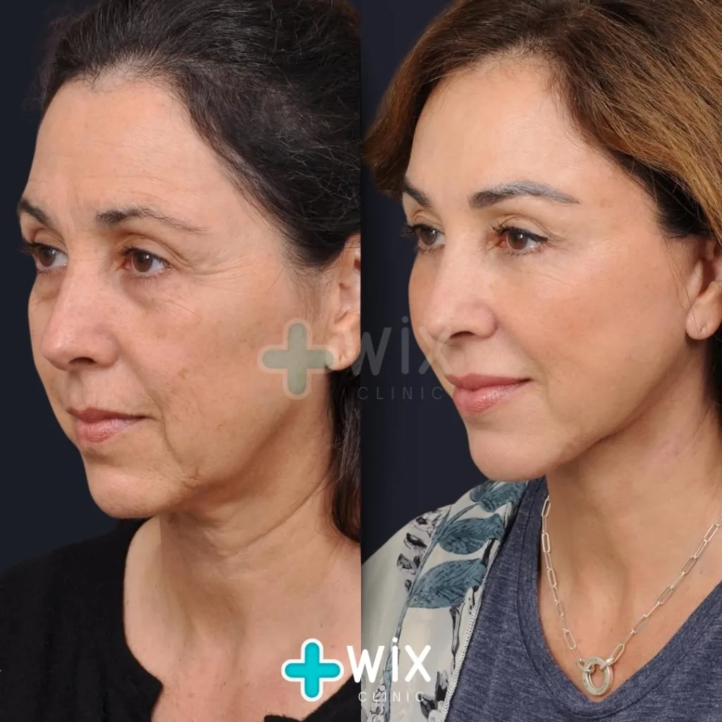 Facelift before and after