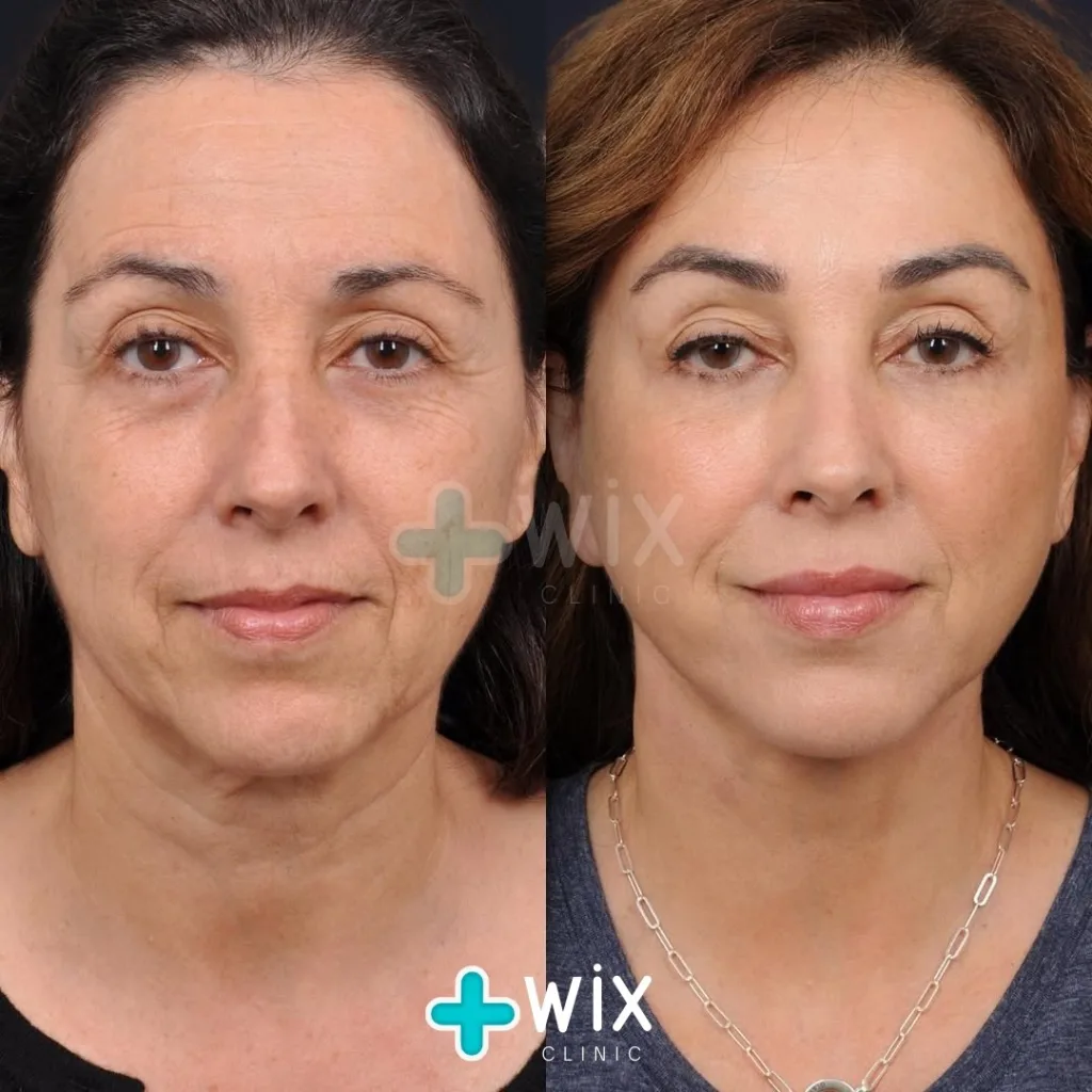 Facelift before and after