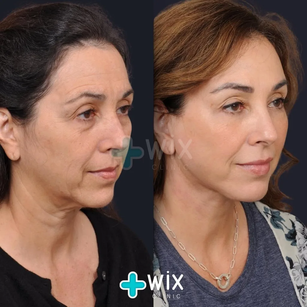 Facelift before and after