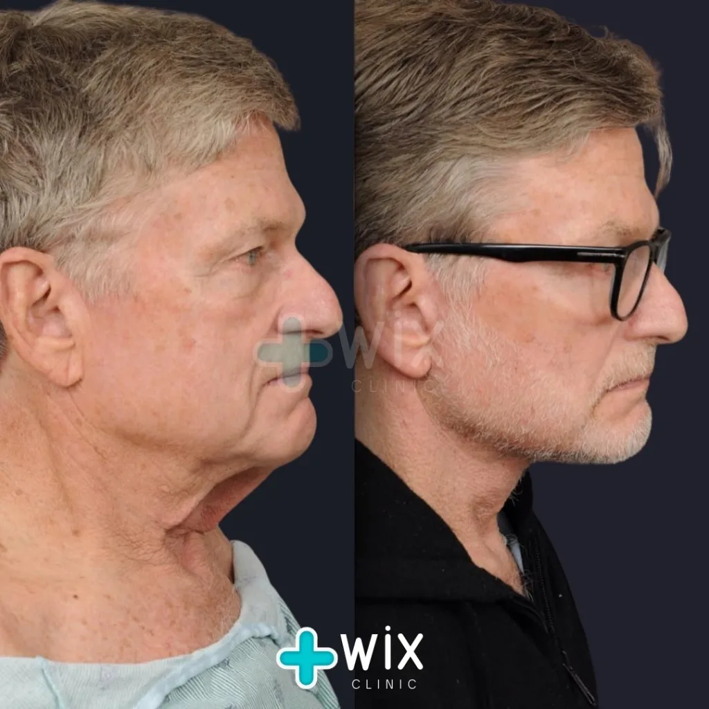 Facelift before and after