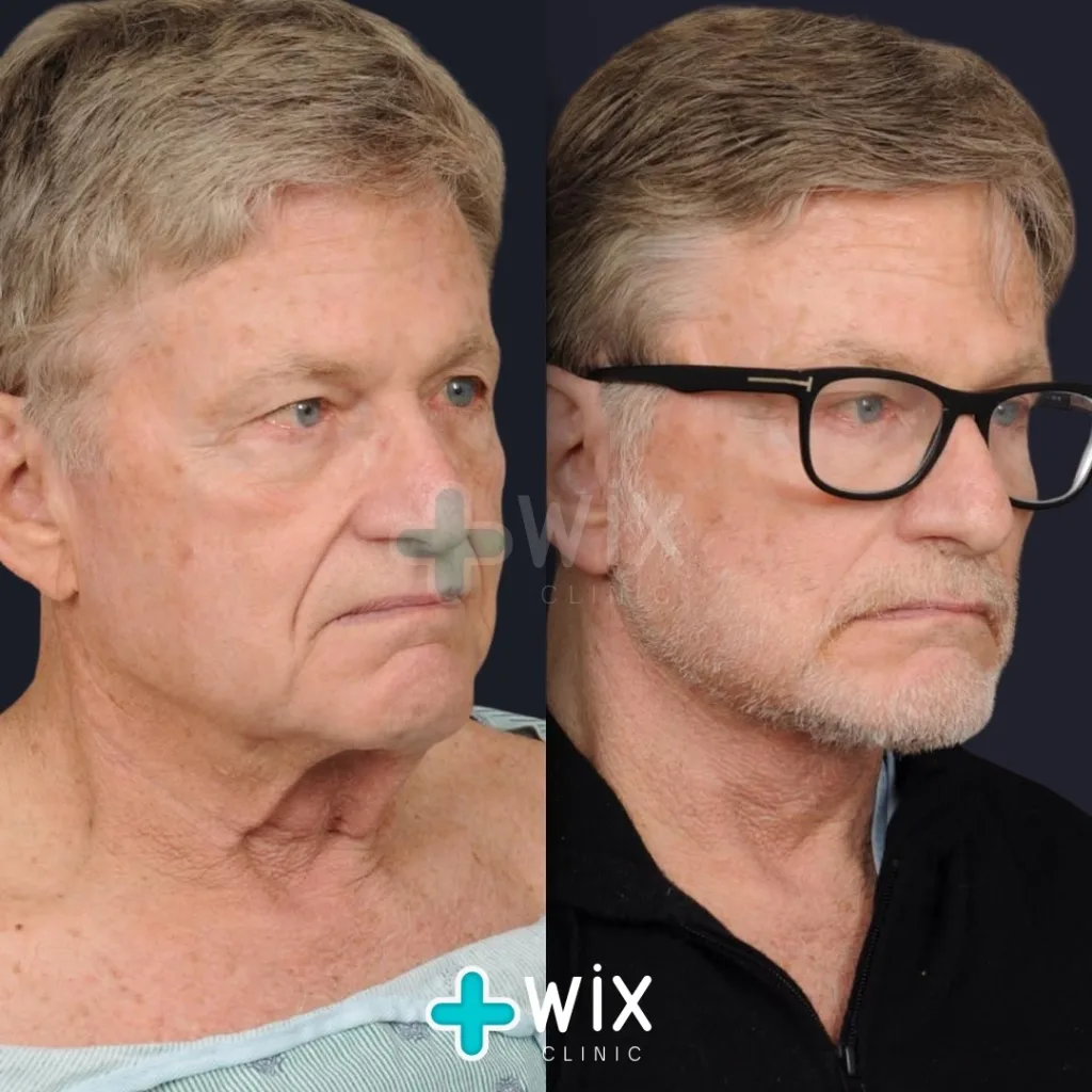 Facelift before and after