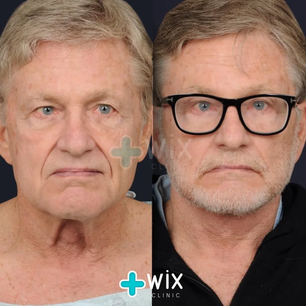 Facelift before and after