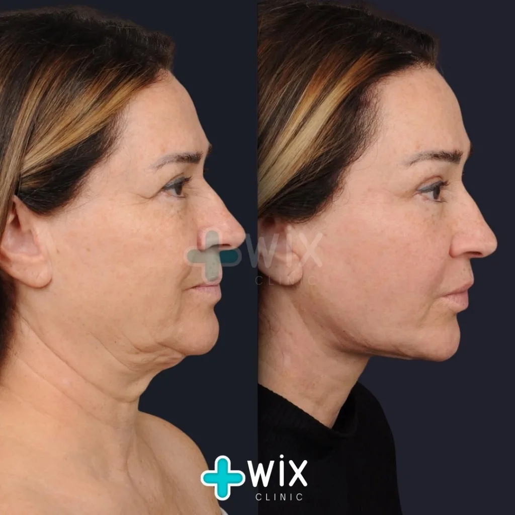 Facelift before and after