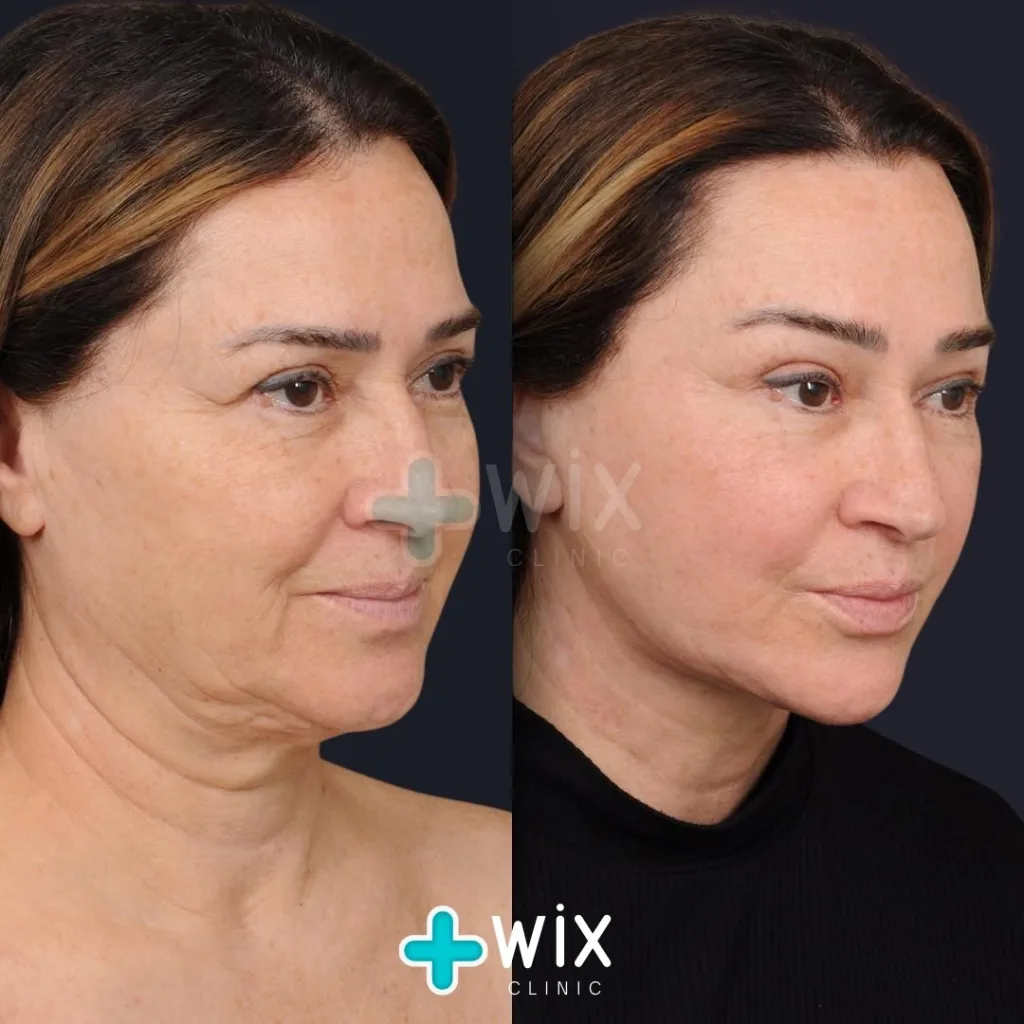 Facelift before and after