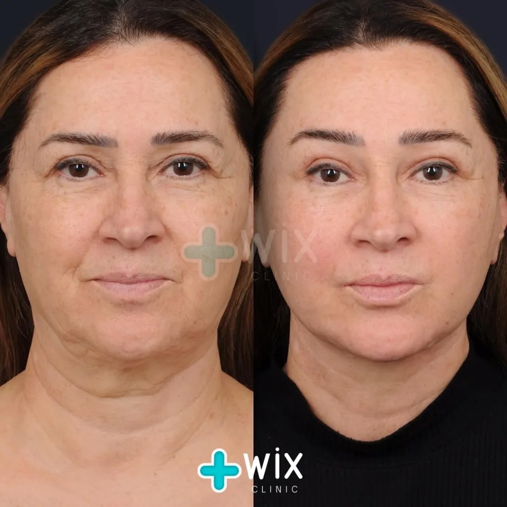 Facelift before and after