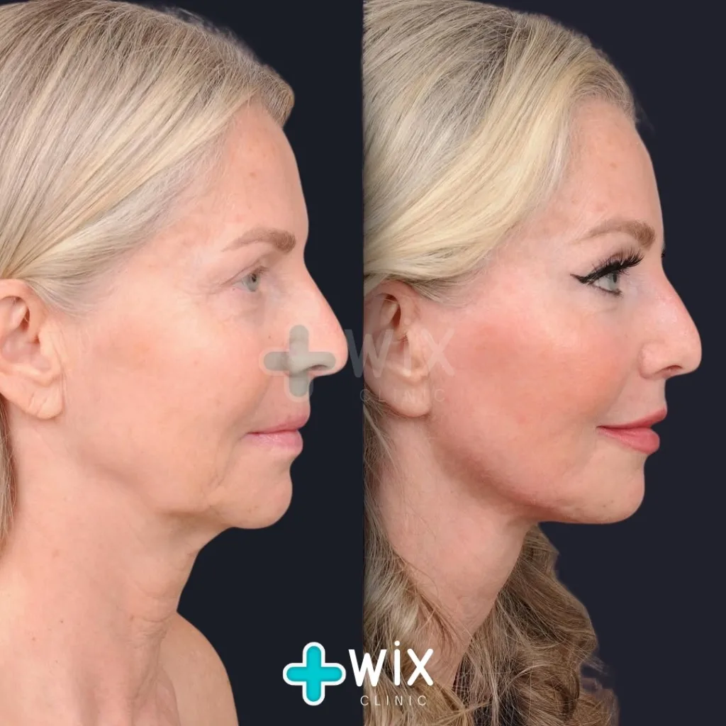 Facelift before and after