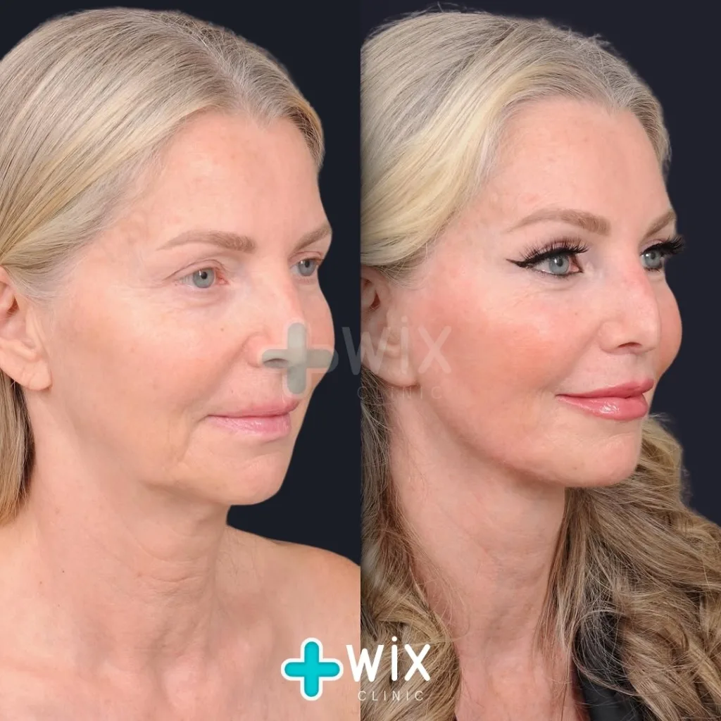 Facelift before and after