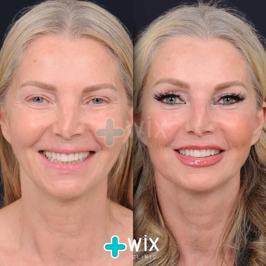 Facelift before and after