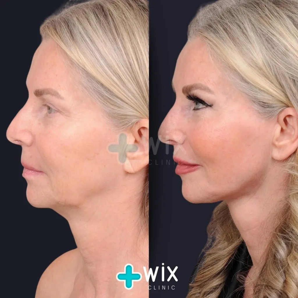 Facelift before and after