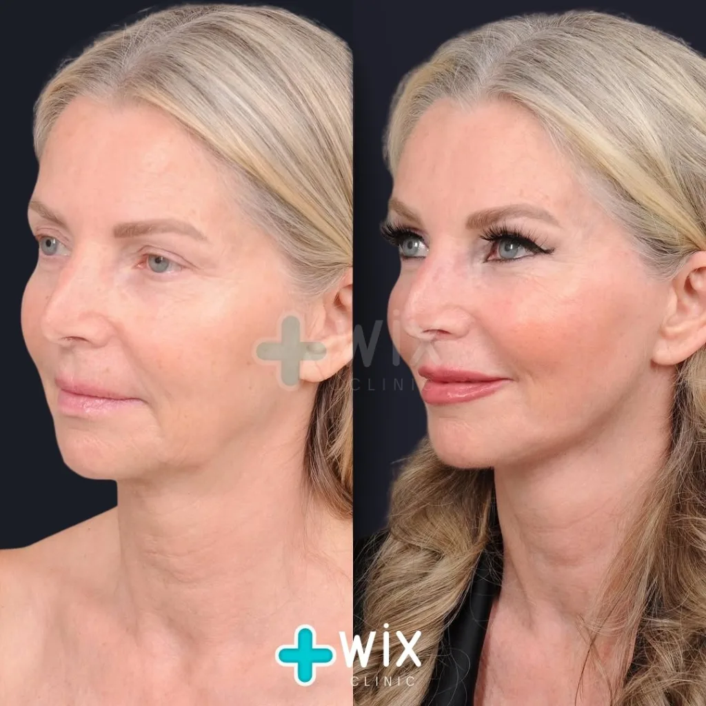 Facelift before and after