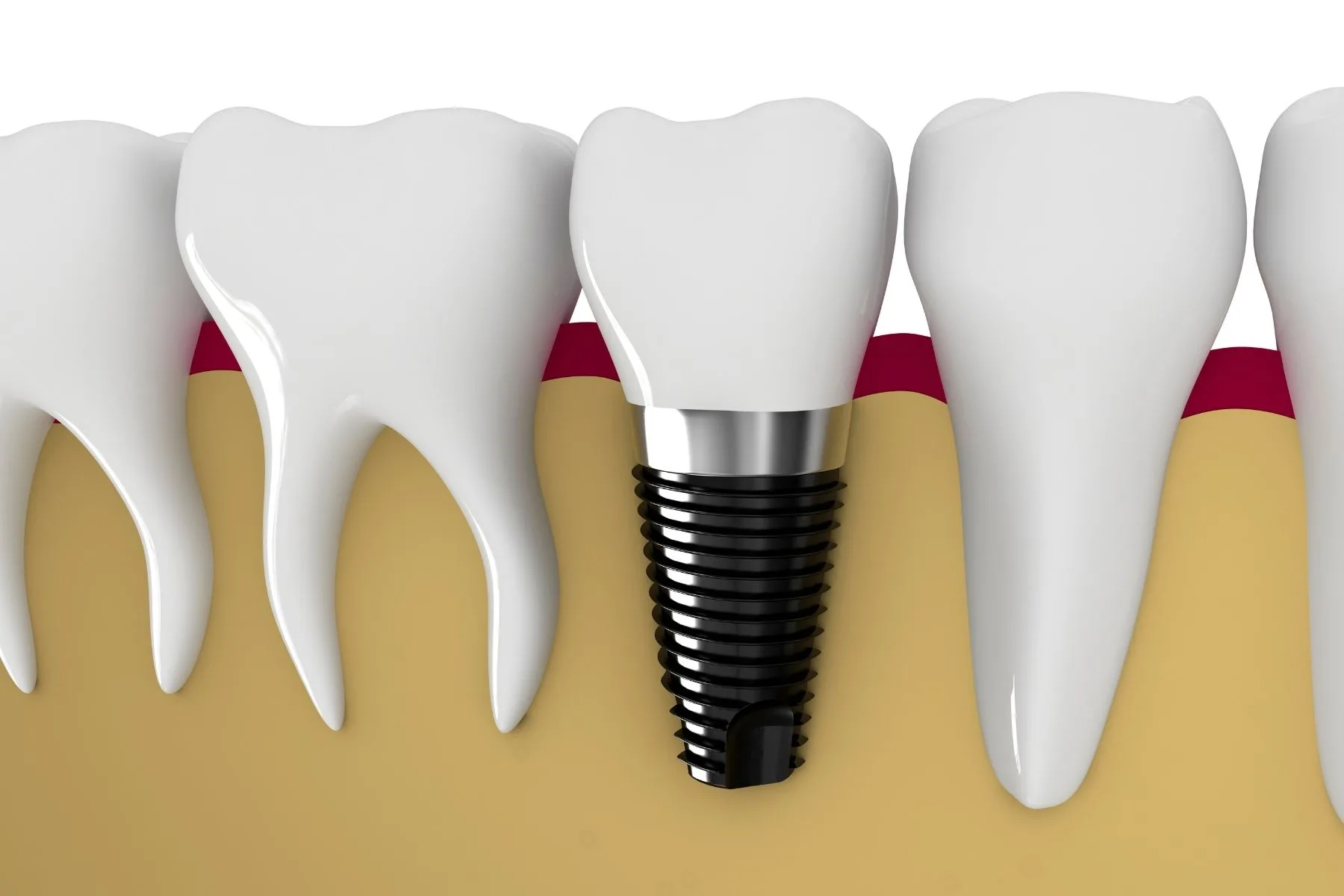 Flapless Dental Implants in Turkey 1 Flapless Dental Implants in Turkey