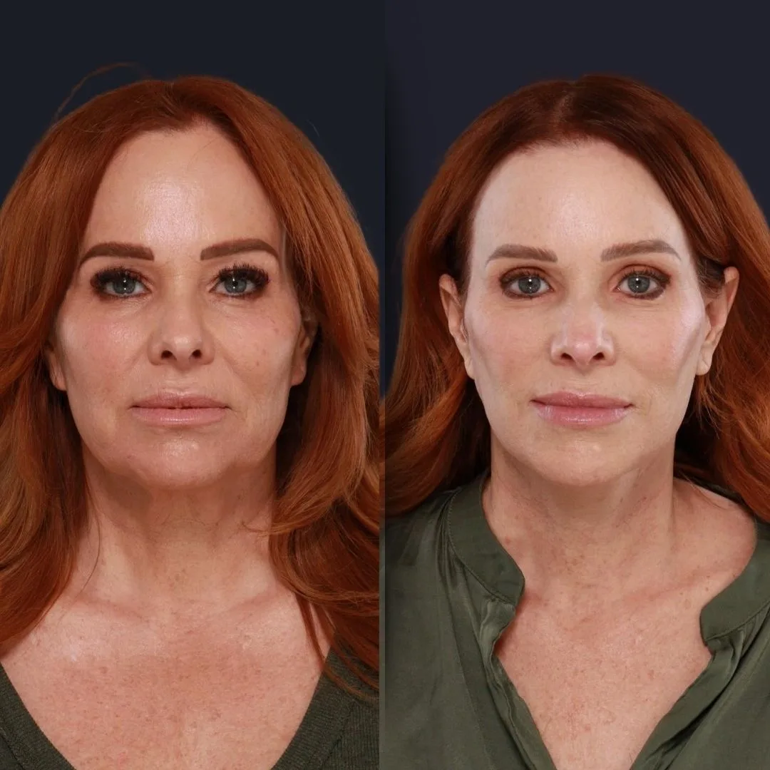 Forehead Reduction - Before and After