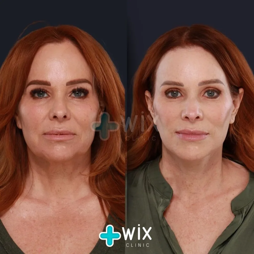 Forehead Reduction Before and After