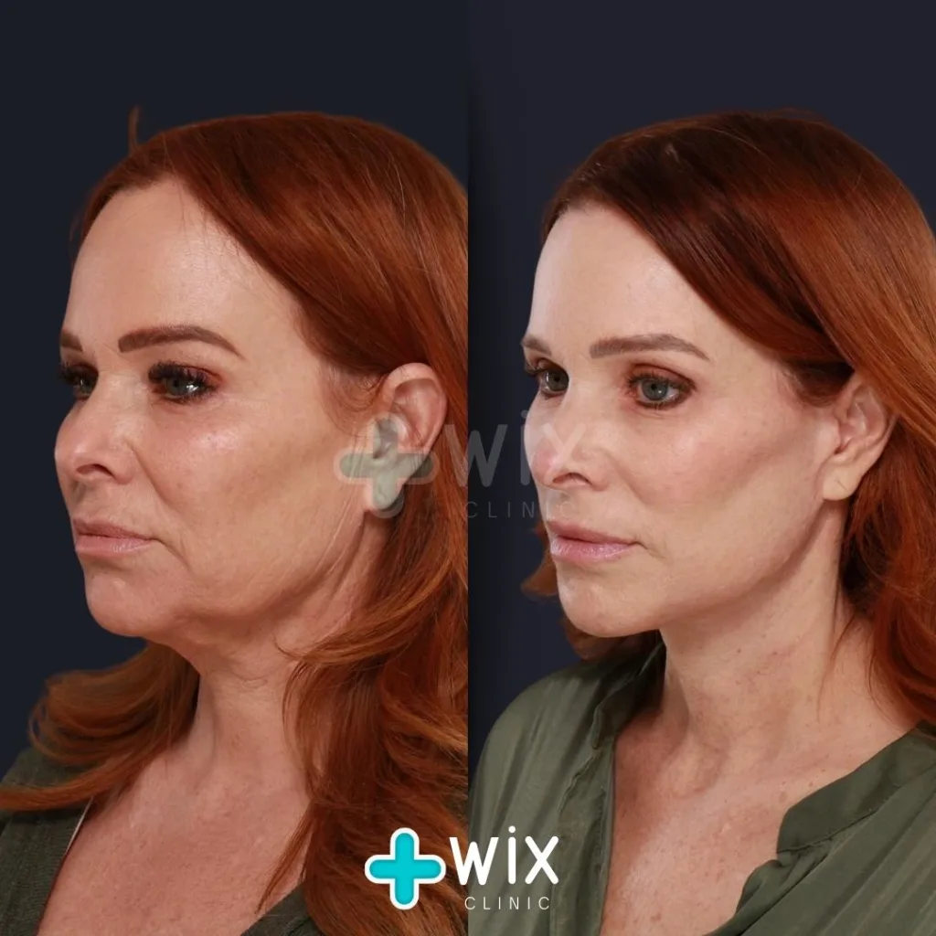 Forehead Reduction Before and After